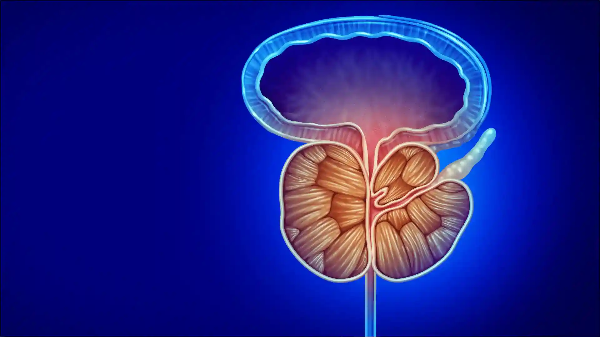 Hiperplasia Prostática