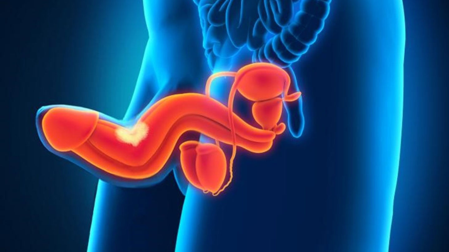 Enfermedad de Peyronie